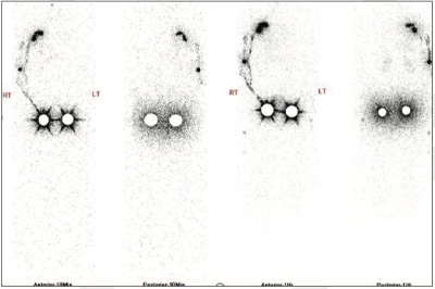 Lymphatic-Sentinel-Lymph Node-Scintigraphy