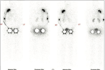 Lymphatic-Sentinel-Lymph Node-Scintigraphy