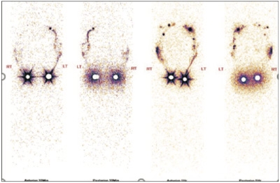 Lymphatic-Sentinel-Lymph Node-Scintigraphy