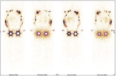 Lymphatic-Sentinel-Lymph Node-Scintigraphy