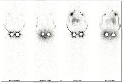 Lymphatic-Sentinel-Lymph Node-Scintigraphy