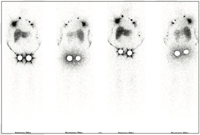 Lymphatic-Sentinel-Lymph Node-Scintigraphy