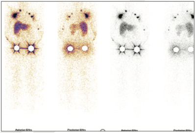 Lymphatic-Sentinel-Lymph Node-Scintigraphy