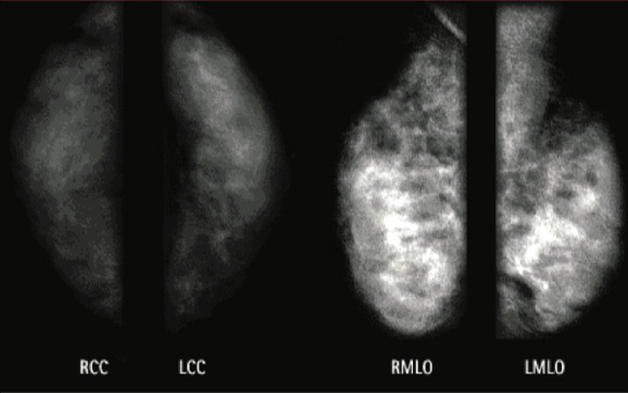 Breast Imaging