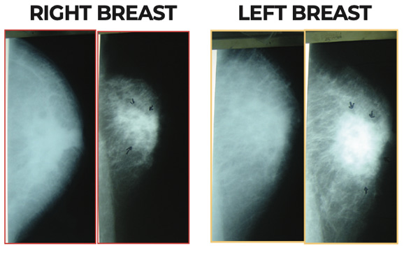 Breast Imaging