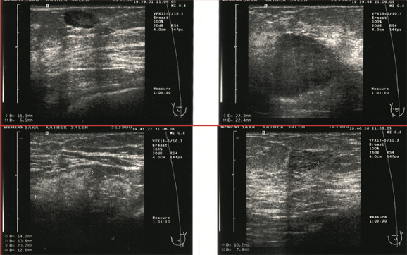 Breast Imaging