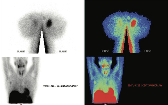 Breast Imaging