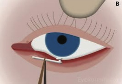 Ophthalmology